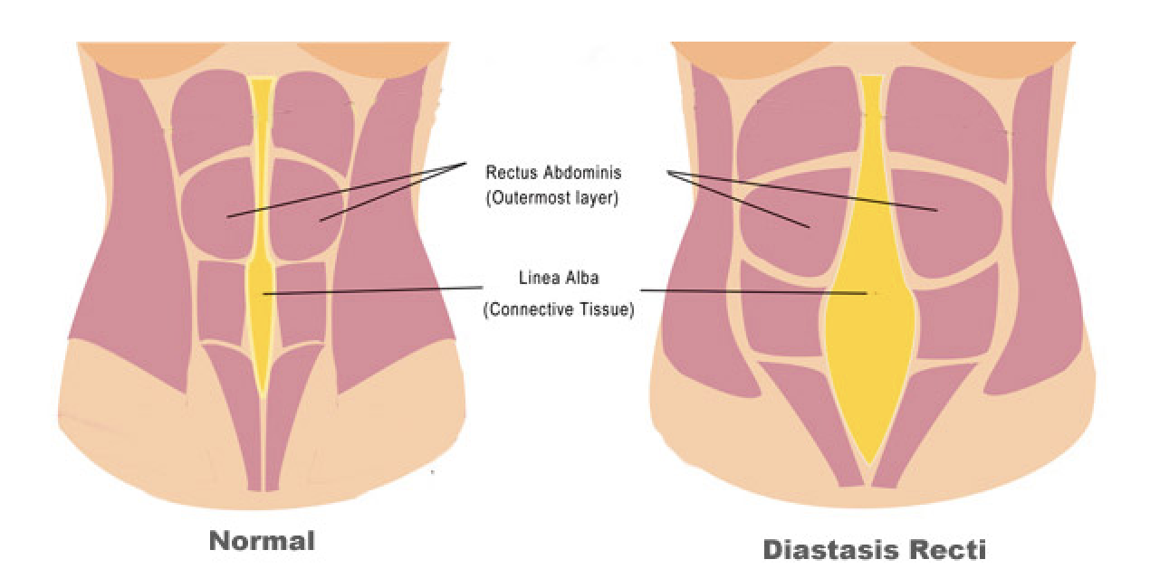 Everything You Need to Know About Diastasis Recti